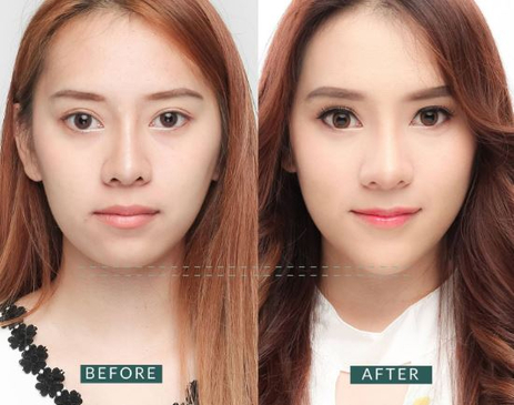 Slider image (6) Thailand Plastic Surgeon - Dr. Oumyos Rattanamahattana